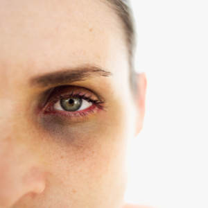 close-up of a woman with a black eye